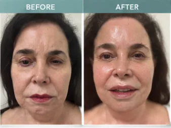 HIFU client 1: before and after photos