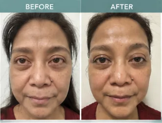 HIFU client 2: before and after photos