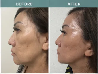 HIFU client 8: before and after photos